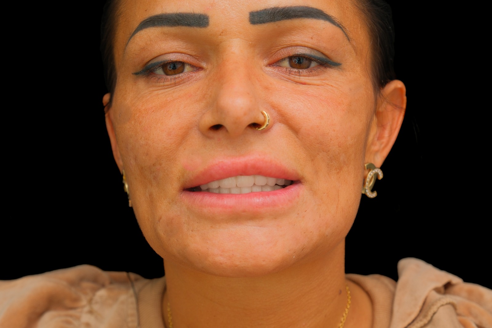 Before and after dental case 4