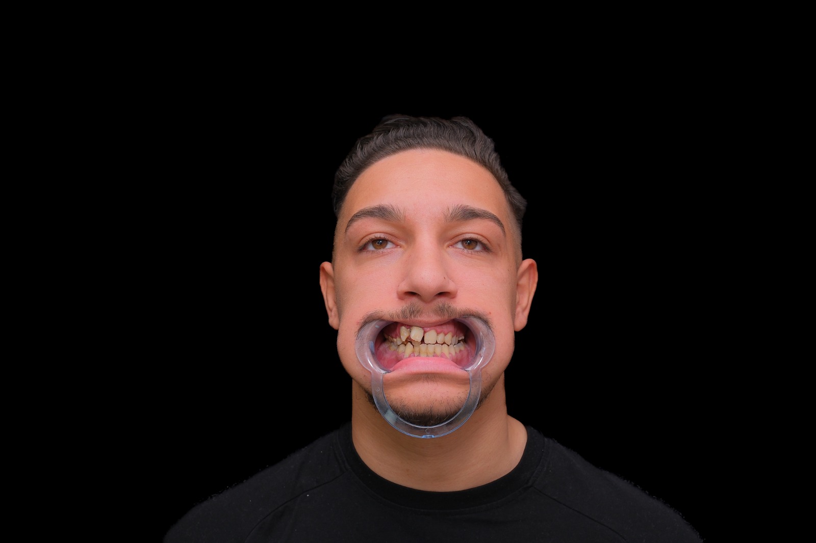 Before and after dental case 2